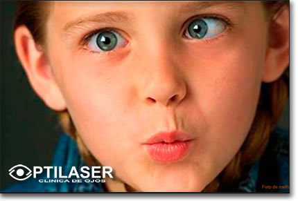 Clinica de ojos Optilaser - Estrabismo